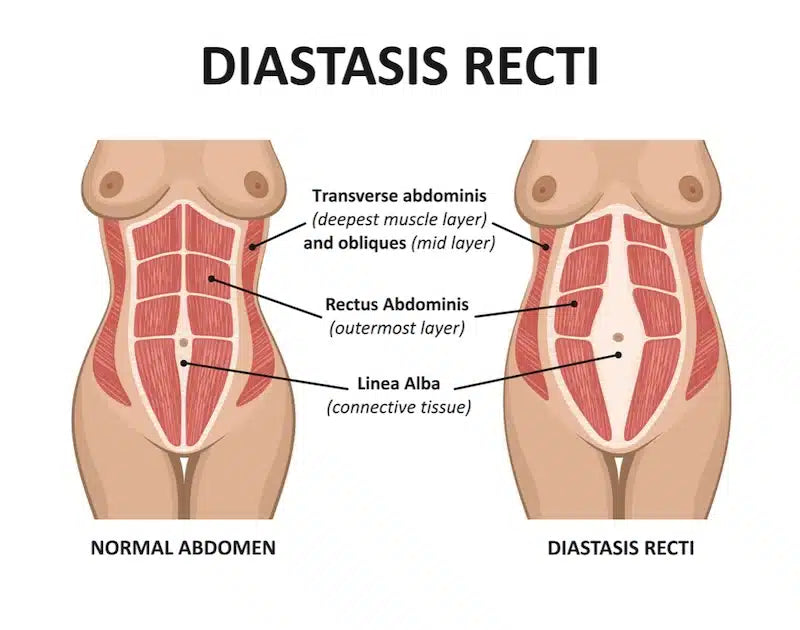Postpartum Exercises for Diastasis Recti: A Gentle Core Recovery Guide